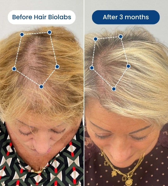 Clinical Regrowth Filler by Hair Biolabs™