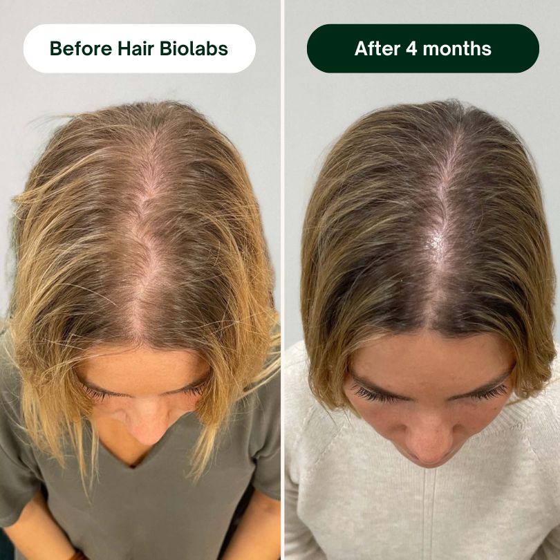 Hair Biolabs REDENSIFY™ - Stops Hair Loss in 21 Days