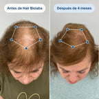 Sistema de Microinfusión Capilar de Doble Acción Hair Biolabs®