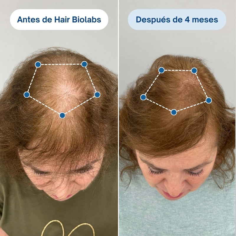 Sistema de Microinfusión Capilar de Doble Acción Hair Biolabs®