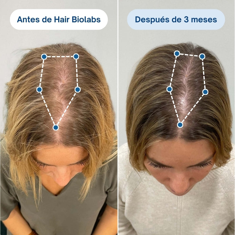 Sistema de Microinfusión Capilar de Doble Acción Hair Biolabs®