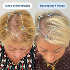 Sistema de Microinfusión Capilar de Doble Acción Hair Biolabs®