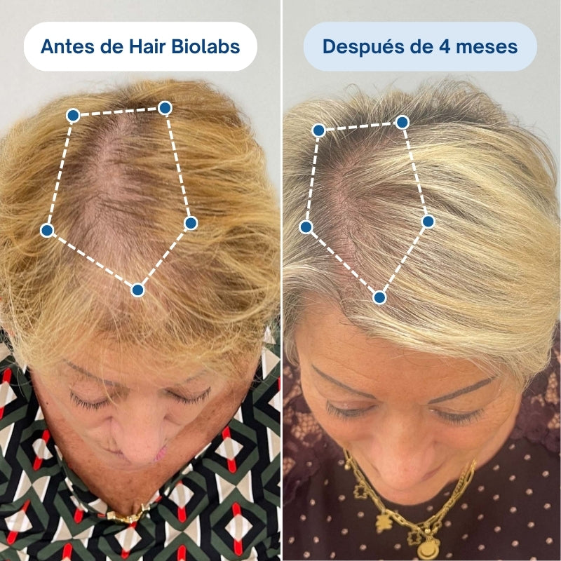 Sistema de Microinfusión Capilar de Doble Acción Hair Biolabs®