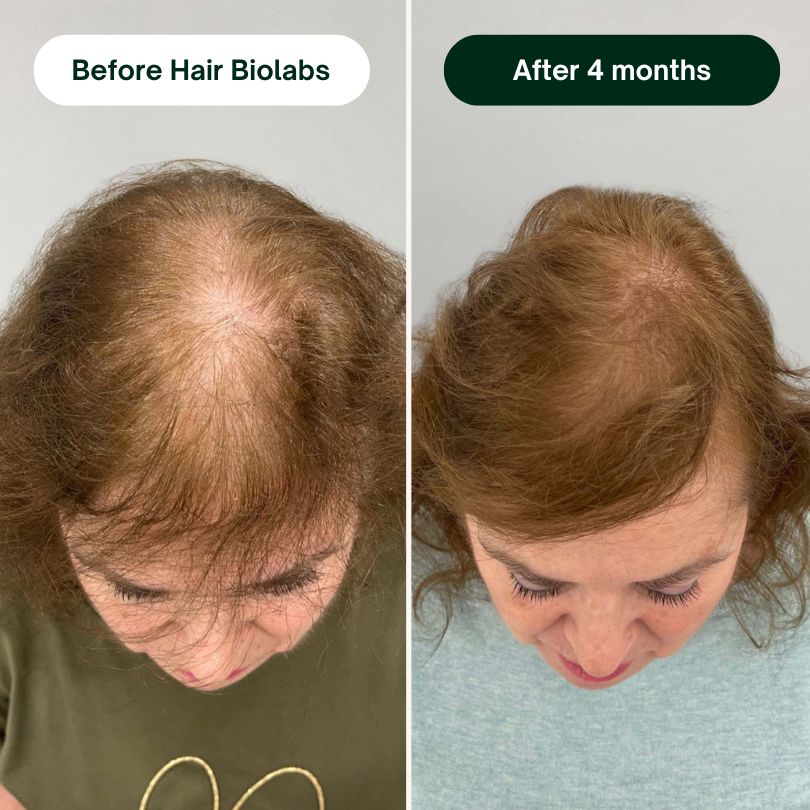Hair Biolabs REDENSIFY™ - Stops Hair Loss in 21 Days