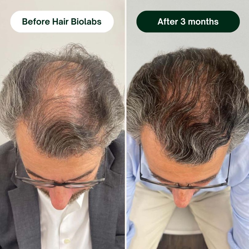 Hair Biolabs™ Hair Regrowth Micro-Infusion System