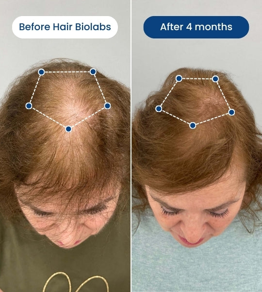 Clinical Regrowth Filler by Hair Biolabs™